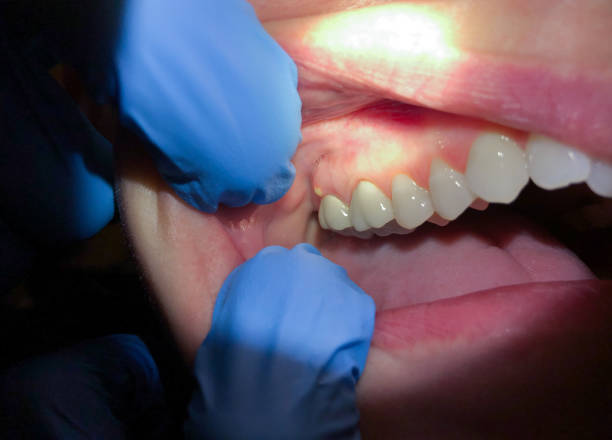 Best Emergency Dental Extractions in Frackville, PA